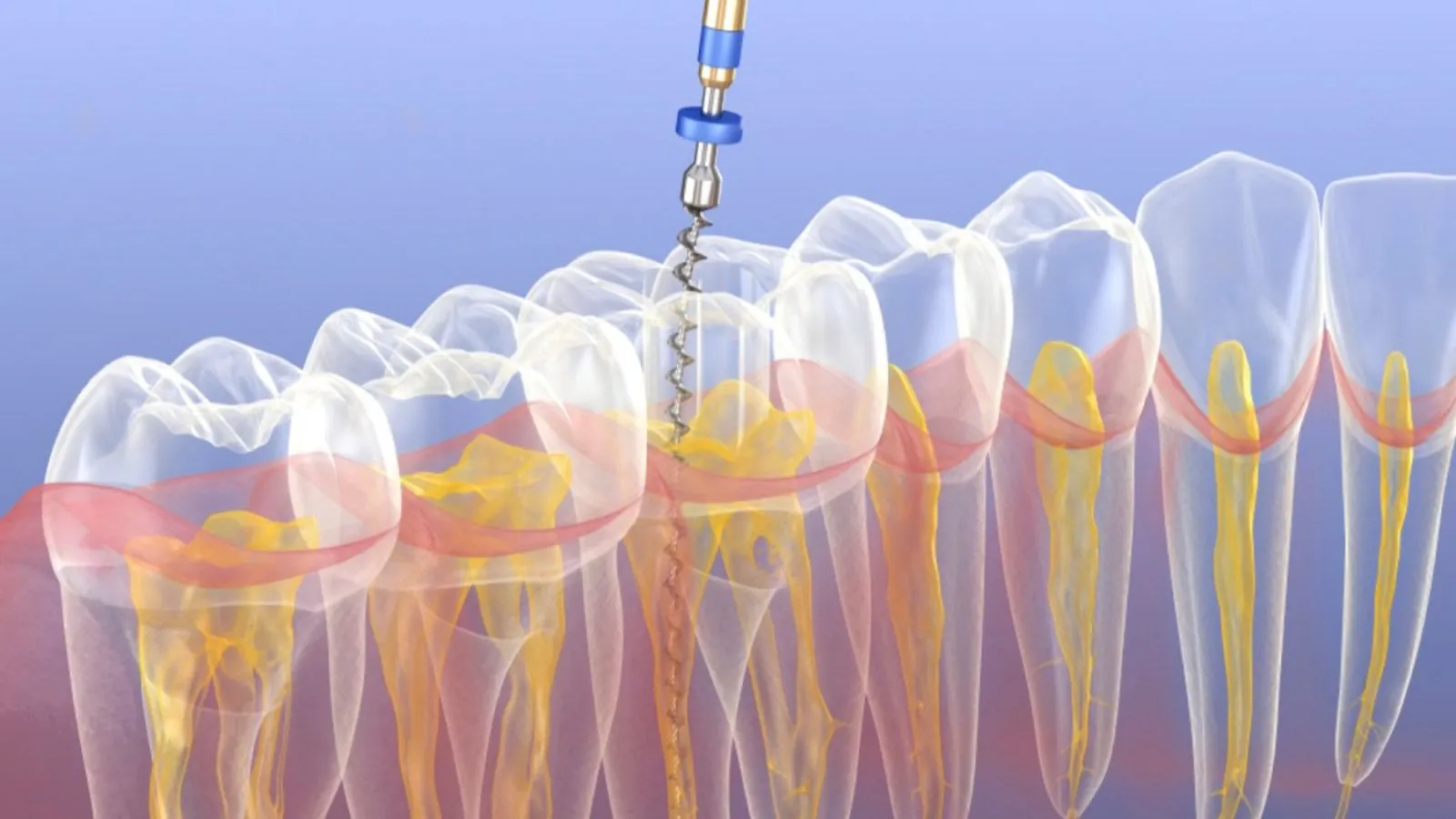 Top Root Canal Myths