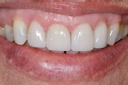 get a perfect smile from Dentist Arcadia - before