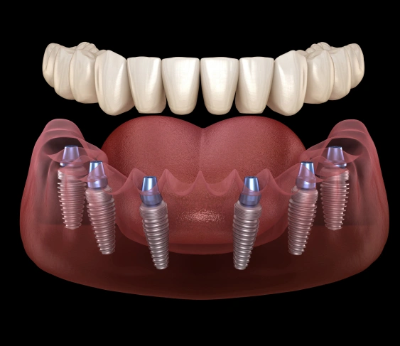 All‑on‑X Implants