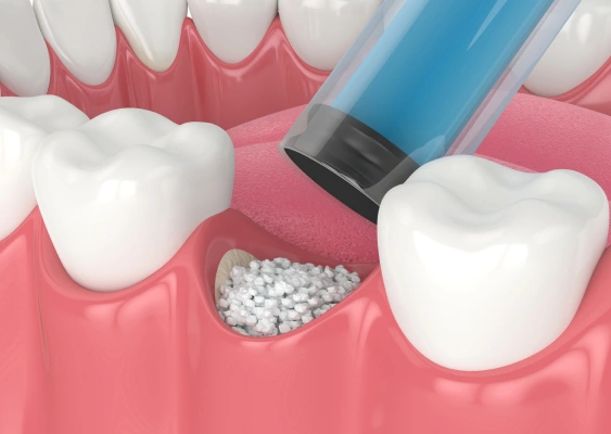 Bone & Sinus Grafting