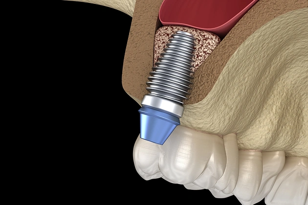img-bone-sinus-grafting