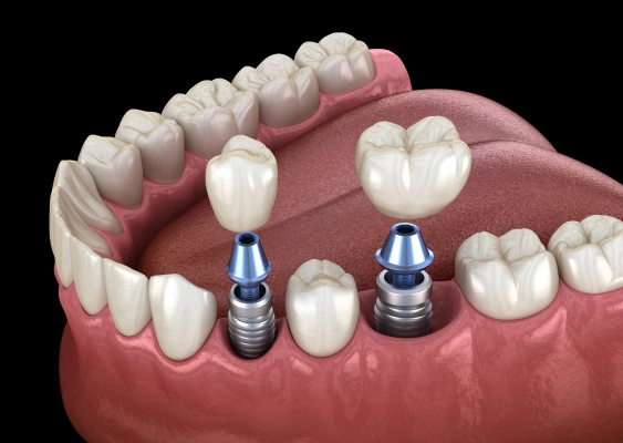 Multiple Tooth Implants 