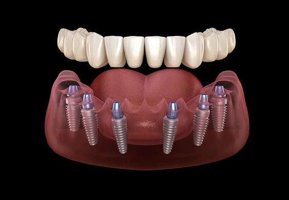 All‑on‑X Implants