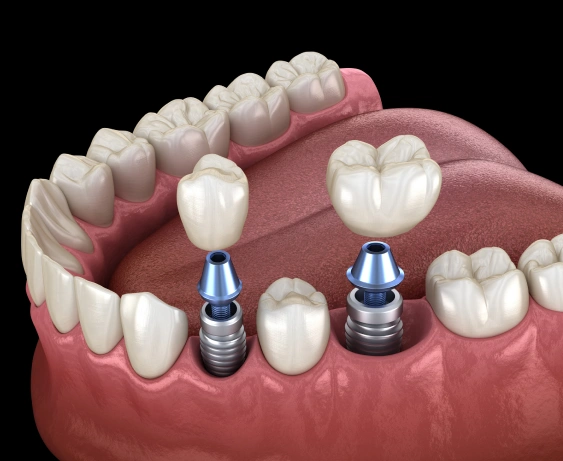 Multiple Tooth Implants in Arcadia