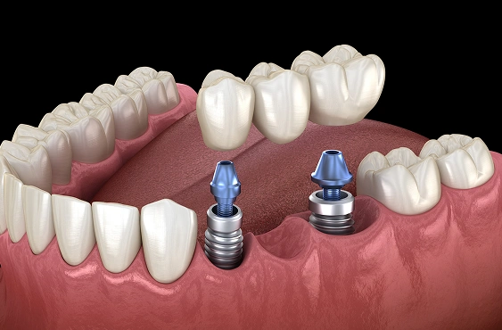 Multiple Tooth Implants