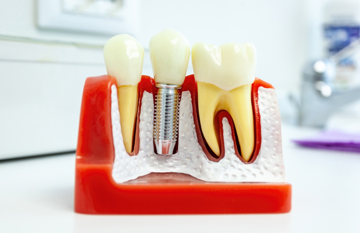 Close up of a dental implant model