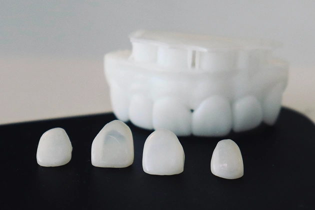 3D Printed Veneers in Arcadia